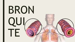 BRON
QUI
TE
 