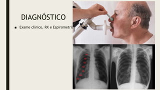 DIAGNÓSTICO
■ Exame clínico, RX e Espirometria
 