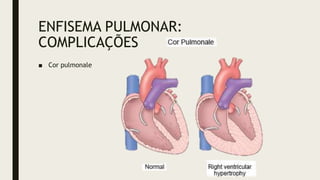 ENFISEMA PULMONAR:
COMPLICAÇÕES
■ Cor pulmonale
 