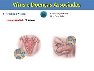 Vírus e Doenças Associadas
Vírus e Doenças Associadas
9) Principais Viroses
Hespes Genital
Hespes Genital - Sintomas
- Sintomas
Herpes simplex tipo II
Vírus Capsulado
 