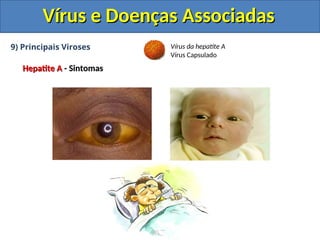 Vírus e Doenças Associadas
Vírus e Doenças Associadas
9) Principais Viroses
Hepatite A
Hepatite A - Sintomas
- Sintomas
Vírus da hepatite A
Vírus Capsulado
 