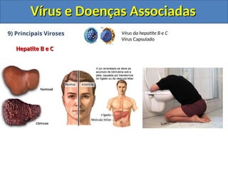 Vírus e Doenças Associadas
Vírus e Doenças Associadas
9) Principais Viroses
Hepatite B e C
Hepatite B e C
Vírus da hepatite B e C
Vírus Capsulado
 