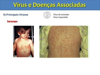 Vírus e Doenças Associadas
Vírus e Doenças Associadas
9) Principais Viroses
Sarampo
Sarampo
Vírus do sarampo
Vírus Capsulado
 