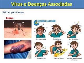 Vírus e Doenças Associadas
Vírus e Doenças Associadas
9) Principais Viroses
Dengue
Dengue
 