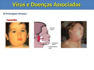 Vírus e Doenças Associadas
Vírus e Doenças Associadas
9) Principais Viroses
Caxumba
Caxumba
 