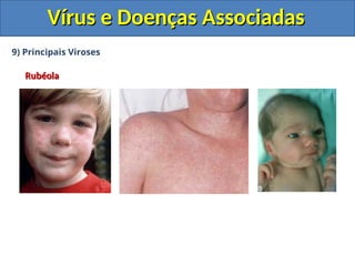 Vírus e Doenças Associadas
Vírus e Doenças Associadas
9) Principais Viroses
Rubéola
Rubéola
 