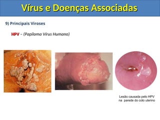 Vírus e Doenças Associadas
Vírus e Doenças Associadas
9) Principais Viroses
HPV
HPV – (Papiloma Vírus Humano)
Lesão causada pelo HPV
na parede do colo uterino
 