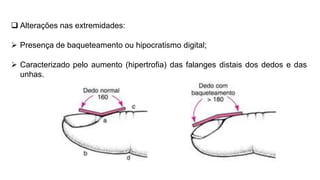  Alterações nas extremidades:
 Presença de baqueteamento ou hipocratismo digital;
 Caracterizado pelo aumento (hipertrofia) das falanges distais dos dedos e das
unhas.
 