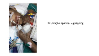 Respiração agônica = gaspping
Vídeo de Propriedade do Autor
 