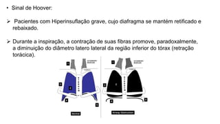 • Sinal de Hoover:
 Pacientes com Hiperinsuflação grave, cujo diafragma se mantém retificado e
rebaixado.
 Durante a inspiração, a contração de suas fibras promove, paradoxalmente,
a diminuição do diâmetro latero lateral da região inferior do tórax (retração
torácica).
 