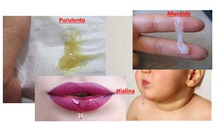 Expectoração:
Purulento
Mucóide
Hialina
 