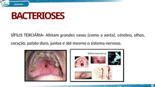 BACTERIOSES
SÍFILIS TERCIÁRIA- Afetam grandes vasos (como a aorta), cérebro, olhos,
coração, palato duro, juntas e até mesmo o sistema nervoso.
23
 