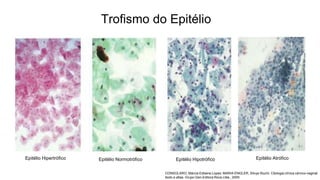 Trofismo do Epitélio
Epitélio Hipertrófico Epitélio HipotróficoEpitélio Normotrófico Epitélio Atrófico
CONSOLARO, Márcia Edilaine Lopes; MARIA-ENGLER, Silvya Stuchi. Citologia clínica cérvico-vaginal:
texto e atlas. Grupo Gen-Editora Roca Ltda., 2000.
 