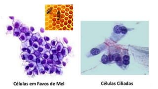 Constituintes Normais do Esfregaço Cervicovaginal