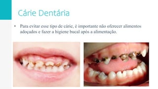 • Para evitar esse tipo de cárie, é importante não oferecer alimentos
adoçados e fazer a higiene bucal após a alimentação.
 