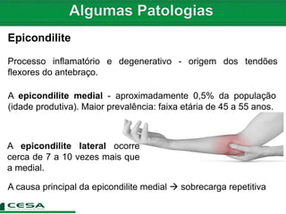 Epicondilite
Processo inflamatório e degenerativo - origem dos tendões
flexores do antebraço.
A epicondilite medial - aproximadamente 0,5% da população
(idade produtiva). Maior prevalência: faixa etária de 45 a 55 anos.
A epicondilite lateral ocorre
cerca de 7 a 10 vezes mais que
a medial.
A causa principal da epicondilite medial  sobrecarga repetitiva
 