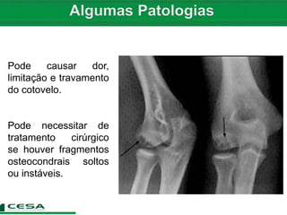 Pode causar dor,
limitação e travamento
do cotovelo.
Pode necessitar de
tratamento cirúrgico
se houver fragmentos
osteocondrais soltos
ou instáveis.
 