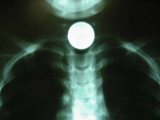 RADIOLOGIA CONVENCIONAL E FORMAÇÃO DOS RAIOS X