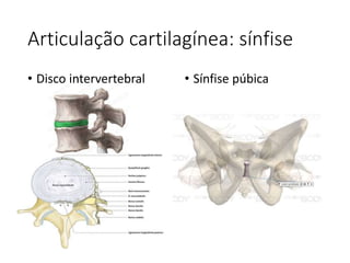 Articulação cartilagínea: sínfise
• Disco intervertebral • Sínfise púbica
 