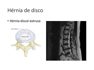 Hérnia de disco
• Hérnia discal extrusa
 