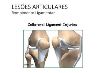 LESÕES ARTICULARES
Rompimento Ligamentar
 