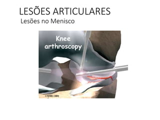 LESÕES ARTICULARES
Lesões no Menisco
 