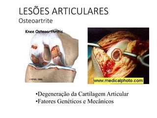 LESÕES ARTICULARES
Osteoartrite
•Degeneração da Cartilagem Articular
•Fatores Genéticos e Mecânicos
 
