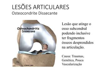 LESÕES ARTICULARES
Osteocondrite Dissecante
Lesão que atinge o
osso subcondral
podendo inclusive
ter fragmentos
ósseos desprendidos
na articulação.
Causa: Traumas,
Genética, Pouca
Vascularização
 