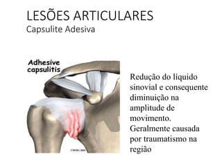 LESÕES ARTICULARES
Capsulite Adesiva
Redução do líquido
sinovial e consequente
diminuição na
amplitude de
movimento.
Geralmente causada
por traumatismo na
região
 