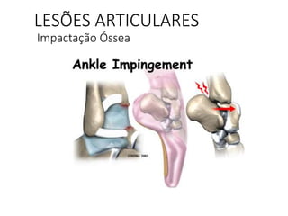 LESÕES ARTICULARES
Impactação Óssea
 