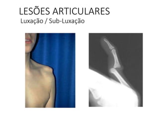 LESÕES ARTICULARES
Luxação / Sub-Luxação
 