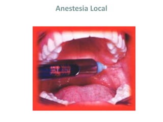 Anestesia Local
 