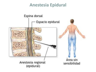 Anestesia Epidural
 