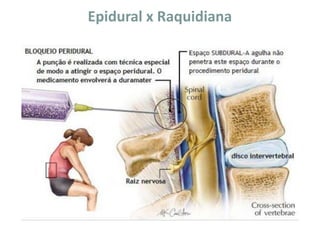 Epidural x Raquidiana
 