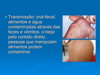 Transmissão: oral-fecal, alimentos e água contaminadas através das fezes e vômitos, o beijo pelo contato direto, pessoas que manipulam alimentos podem contaminar. 