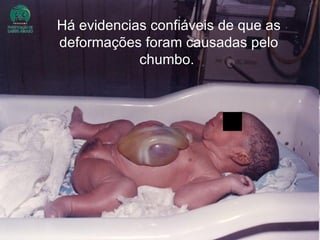 Há evidencias confiáveis de que as deformações foram causadas pelo chumbo.   