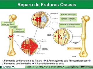 1.Formação do hematoma de fratura  2.Formação do calo fibrocartilaginoso 
3.Formação do calo ósseo  4.Remodelamento do osso
Reparo de Fraturas Ósseas
 