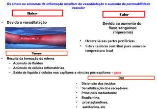 Os sinais ou sintomas da inflamação resultam da vasodilatação e aumento da permeabilidade
vascular
Rubor
• Devido a vasodilatação
• Ocorre só nas partes periféricas
• Febre também contribui para aumento
temperatura local
Calor
Devido ao aumento do
fluxo sanguíneo
(hiperemia)
Tumor
• Resulta da formação do edema
– Acúmulo de fluidos
– Acúmulo de células inflamatórias
– Saída de líquido e células nos capilares e vênulas pós-capilares - gaps
Dor
• Distensão dos tecidos
• Sensibilização dos receptores
• Principais mediadores:
• Bradicinina,
• prostaglandinas,
• serotonina, etc
 