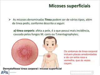 Micoses superficiais
 As micoses denominadas Tinea podem ser de vários tipos, além
da tinea pedis, conforme descrito a seguir:
a) tinea corporis: afeta a pele, é a que possui mais incidência,
causada pelos fungos M. canis ou T.mentagrophytes;
Os sintomas de tinea corporal
incluem placas arredondadas
e de cor entre rosa e
vermelha, que às vezes
coçam.
Dermatofitose/ tinea corporal / micose superficial
 