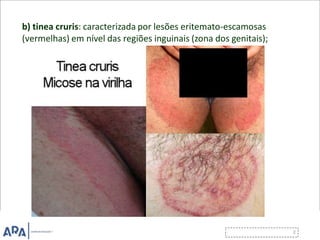 b) tinea cruris: caracterizada por lesões eritemato-escamosas
(vermelhas) em nível das regiões inguinais (zona dos genitais);
 
