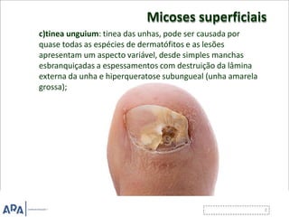 Micoses superficiais
c)tinea unguium: tinea das unhas, pode ser causada por
quase todas as espécies de dermatófitos e as lesões
apresentam um aspecto variável, desde simples manchas
esbranquiçadas a espessamentos com destruição da lâmina
externa da unha e hiperqueratose subungueal (unha amarela
grossa);
 