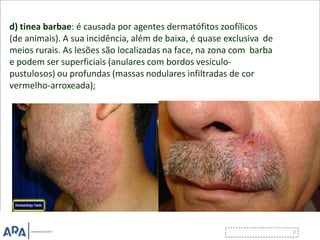 d) tinea barbae: é causada por agentes dermatófitos zoofílicos
(de animais). A sua incidência, além de baixa, é quase exclusiva de
meios rurais. As lesões são localizadas na face, na zona com barba
e podem ser superficiais (anulares com bordos vesiculo-
pustulosos) ou profundas (massas nodulares infiltradas de cor
vermelho-arroxeada);
 