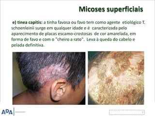 Micoses superficiais
e) tinea capitis: a tinha favosa ou favo tem como agente etiológico T.
schoenleinii surge em qualquer idade e é caracterizada pelo
aparecimento de placas escamo-crostosas de cor amarelada, em
forma de favo e com o "cheiro a rato". Leva à queda do cabelo e
pelada definitiva.
 