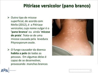 Pitiríase versicolor (pano branco)
 Outro tipo de micose
superficial, de acordo com
Mello (2012), é a Pitíriase
versicolor, cujo nome vulgar é o
‘pano branco’ ou ainda ‘micose
de praia’. Trata-se de uma
micose causada pela levedura
Pityrosporum ovale.
 O fungo causador da doenca
habita a pele de todas as
pessoas. Em algumas delas é
capaz de se desenvolver,
provocando manchas brancas
ou marrons.
 