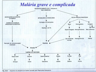 Malária grave e complicada
 