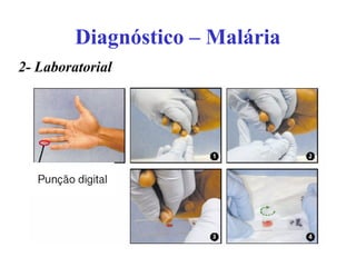 Diagnóstico – Malária
2- Laboratorial
 