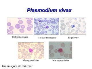 Plasmodium vivaxPlasmodium vivax
Microgametócito Macrogametócito
EsquizonteTrofozoítos maduroTrofozoíto jovem
Granulações de Shüffner
 
