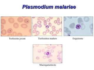 Plasmodium malariaePlasmodium malariae
Trofozoíto jovem Trofozoítos maduro
Macrogametócito
Esquizonte
 