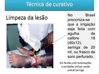 No Brasil
preconiza-se
que a irrigação
seja feita com
agulha de
calibre 18
(40x12),
seringa de 20
ml, ou frasco de
soro perfurado.
 