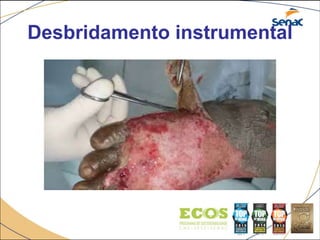 Desbridamento instrumental
 